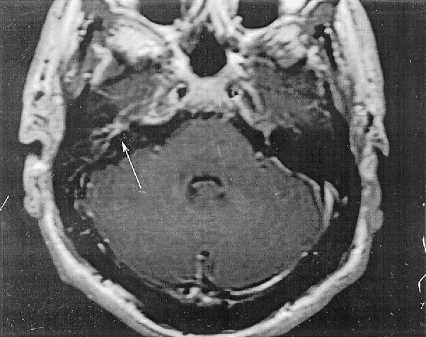 Panah putih menunjukkan enhancement dari ganglion genikulatum dari saraf fasialis kanan. (Sobn, Amin and P A Tranmer. “Ramsay Hunt syndrome in a patient with human immunodeficiency virus infection.” The Journal of the American Board of Family Practice 14 5 (2001): 392-4 )